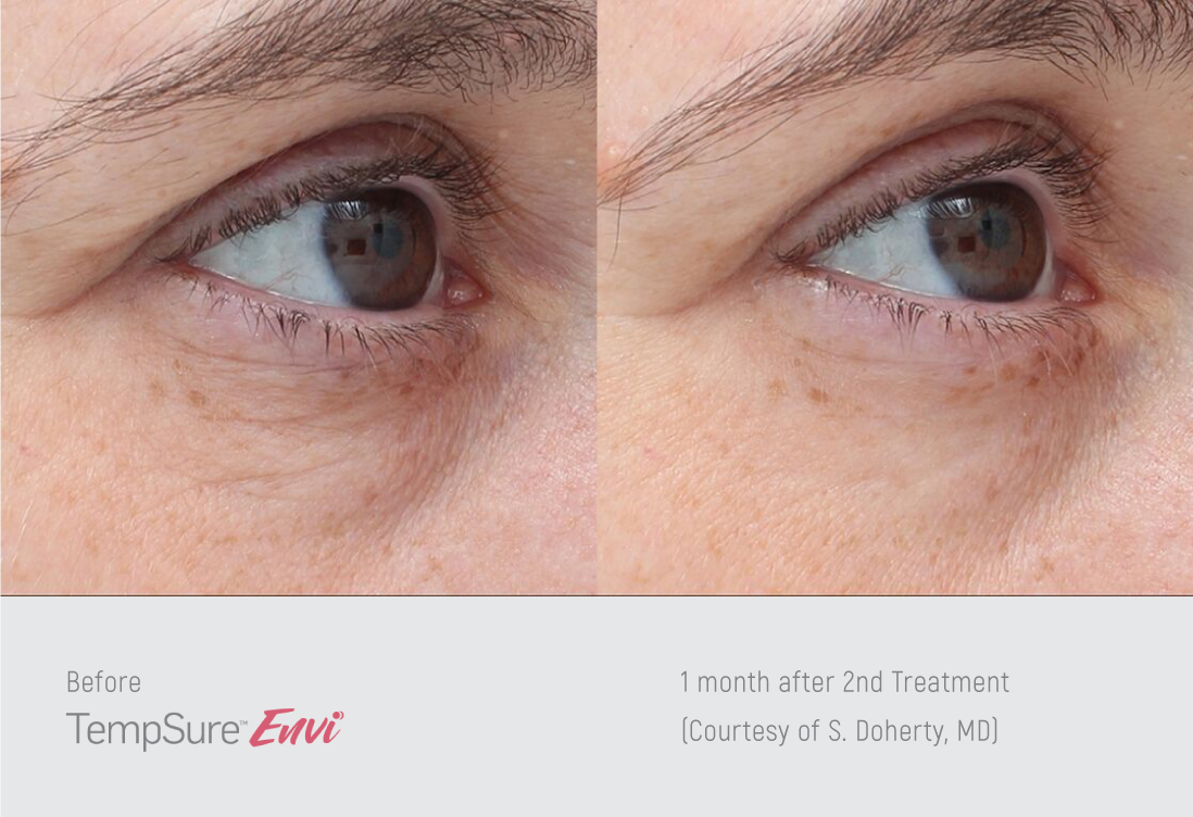 Before and After TempSure Envi Treatments